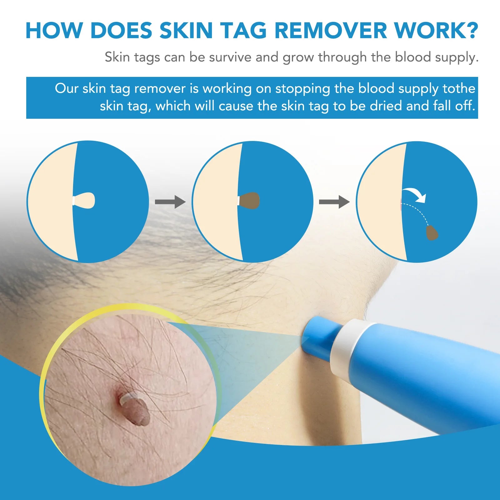 2 in 1 Auto Skin Tag Remover Kit Micro Skin Tag Removal Device Adult Mole Stain Wart Remover Face Care Beauty Tools Dropshipping